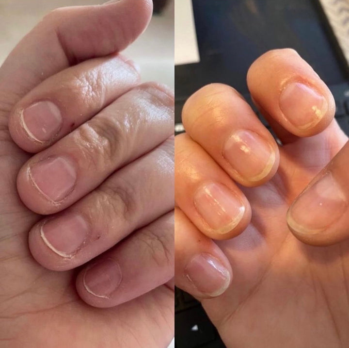 Firm Foundation nail hardener before and after comparison on short brittle nails